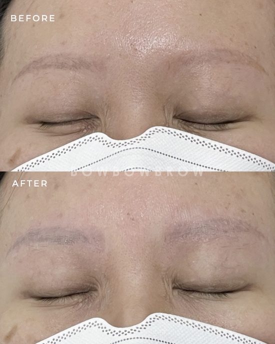 Eyebrow tattoo removal before and after, dark tattooed brows lightened after laser sessions, Bowbowbrow Malaysia