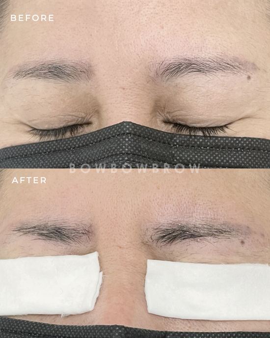 Eyebrow tattoo removal before and after, old embroidery pigment lifted from the brow area, Bowbowbrow Petaling Jaya