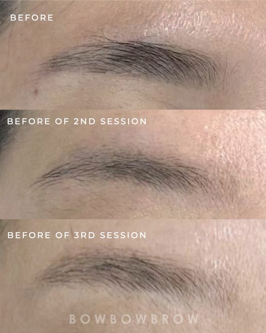 Eyebrow tattoo removal progress across three laser sessions, pigment fading each time, Bowbowbrow Penang