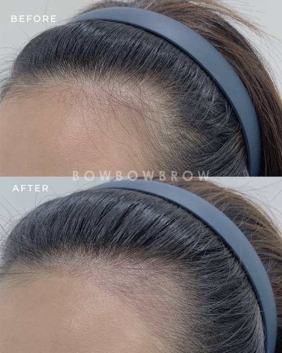 Hairline embroidery before and after, thinning front hairline filled in with fine pigment strokes, Bowbowbrow Malaysia