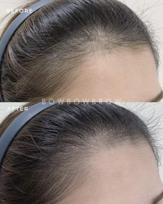 Hairline embroidery before and after, receding temple softened into a fuller natural hairline, Bowbowbrow Petaling Jaya