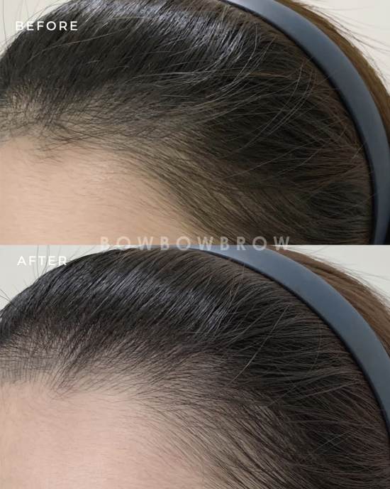 Hairline embroidery before and after, sparse hairline edge given a denser natural blend, Bowbowbrow Penang