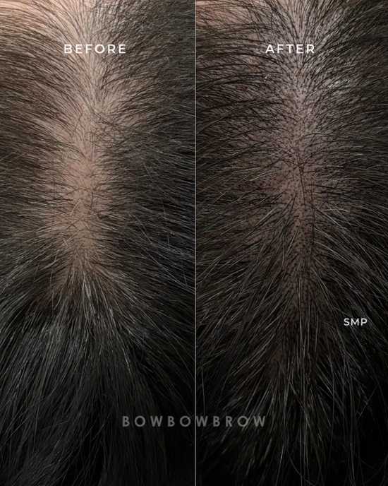 Scalp micropigmentation before and after, thinning crown filled with microdots, Bowbowbrow Malaysia