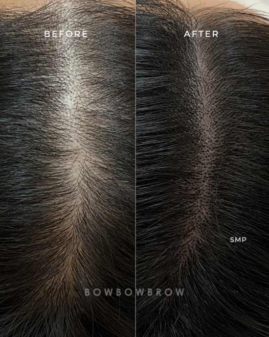 Scalp micropigmentation before and after, widening parting given a denser appearance, Bowbowbrow Petaling Jaya