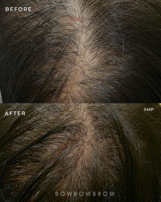 Scalp micropigmentation before and after, bald spot at the crown filled in, Bowbowbrow Penang