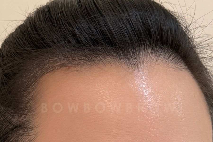 Hairline embroidery result along a thinning front hairline, Bowbowbrow Malaysia
