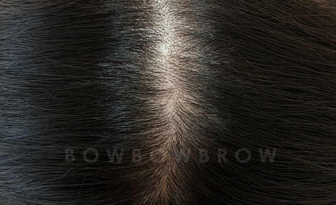 Healed hairline after treatment at Bowbowbrow, fuller parting and hairline, Malaysia